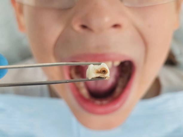 Best Emergency Tooth Extraction in Lawnton, PA